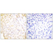 Immunohistochemistry analysis of paraffin-embedded human breast carcinoma tissue, using NKX3.1 antibody.