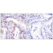 Immunohistochemistry analysis of paraffin-embedded human lung carcinoma tissue, using SENP6 antibody.