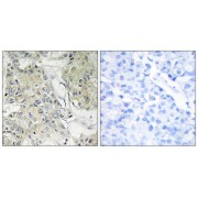 Immunohistochemistry analysis of paraffin-embedded human breast carcinoma tissue, using TM16J antibody.
