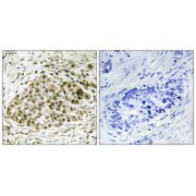 Immunohistochemistry analysis of paraffin-embedded human lung carcinoma tissue, using Lyl-1 antibody.