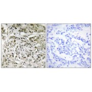 Immunohistochemistry analysis of paraffin-embedded human breast carcinoma tissue, using TAF1 antibody.