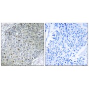 Immunohistochemistry analysis of paraffin-embedded human breast carcinoma tissue, using ETV4 antibody.