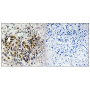 Immunohistochemistry analysis of paraffin-embedded human breast carcinoma tissue, using IRX3 antibody.