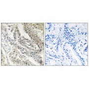 Immunohistochemistry analysis of paraffin-embedded human lung carcinoma tissue, using CRBP III antibody.