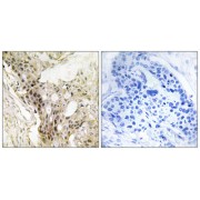 Immunohistochemistry analysis of paraffin-embedded human breast carcinoma tissue, using MED21 antibody.