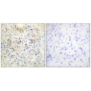 Immunohistochemistry analysis of paraffin-embedded human prostate carcinoma tissue, using TM16G antibody.