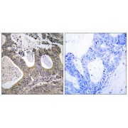 Immunohistochemistry analysis of paraffin-embedded human colon carcinoma tissue, using STEA2 antibody.