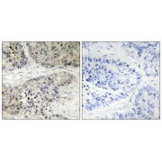 Immunohistochemistry analysis of paraffin-embedded human lung carcinoma tissue, using MAPK15 antibody.