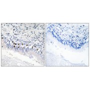 Immunohistochemistry analysis of paraffin-embedded human lung carcinoma tissue, using MED12 antibody.