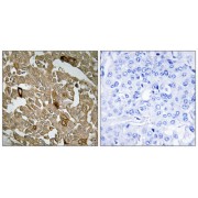 Immunohistochemistry analysis of paraffin-embedded human breast carcinoma tissue, using BTBD6 antibody.