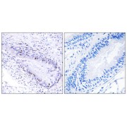 Immunohistochemistry analysis of paraffin-embedded human lung carcinoma tissue, using TEP1 antibody.