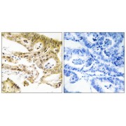 Immunohistochemistry analysis of paraffin-embedded human colon carcinoma tissue, using MED23 antibody.