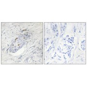 Immunohistochemistry analysis of paraffin-embedded human breast carcinoma tissue, using ZNF232 antibody.