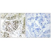 Immunohistochemistry analysis of paraffin-embedded human breast carcinoma tissue using CENPA antibody.