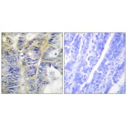 Immunohistochemistry analysis of paraffin-embedded human colon carcinoma tissue using COL4A5 antibody.