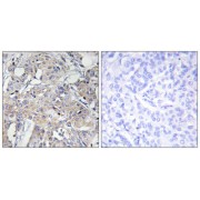 Immunohistochemistry analysis of paraffin-embedded human breast carcinoma tissue using COL6A3 antibody.