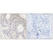 Immunohistochemistry analysis of paraffin-embedded human breast carcinoma tissue, using Cytochrome P450 1A2 antibody.