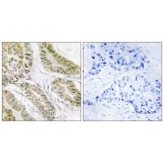 Immunohistochemistry analysis of paraffin-embedded human lung carcinoma tissue using BAX antibody.