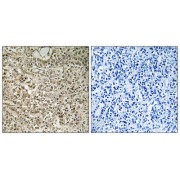 Immunohistochemistry analysis of paraffin-embedded human breast carcinoma tissue using RPL40 antibody.