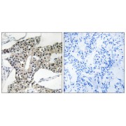 Immunohistochemistry analysis of paraffin-embedded human breast carcinoma tissue using ARSK antibody.