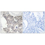 Immunohistochemistry analysis of paraffin-embedded human breast carcinoma tissue using BAGE4 antibody.