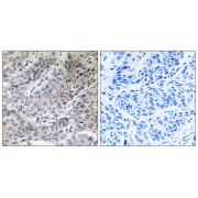 Immunohistochemistry analysis of paraffin-embedded human lung carcinoma tissue using BRP44 antibody.