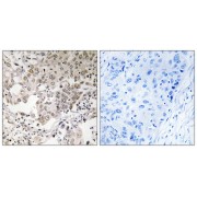 Immunohistochemistry analysis of paraffin-embedded human lung carcinoma tissue using NCAPG2 antibody.