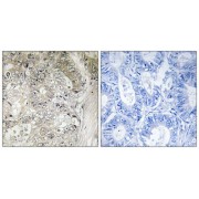 Immunohistochemistry analysis of paraffin-embedded human colon carcinoma tissue using CST1 antibody.