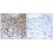 Immunohistochemistry analysis of paraffin-embedded human breast carcinoma tissue using ATG4A antibody.