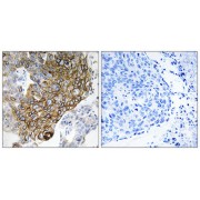 Immunohistochemistry analysis of paraffin-embedded human lung carcinoma tissue using GJA3 antibody.