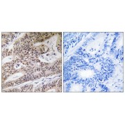 Immunohistochemistry analysis of paraffin-embedded human colon carcinoma tissue using NPHP4 antibody.