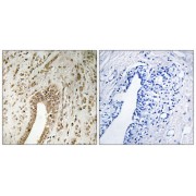 Immunohistochemistry analysis of paraffin-embedded human breast carcinoma tissue using PHF3 antibody.