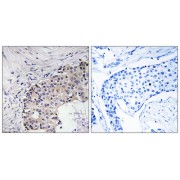 Immunohistochemistry analysis of paraffin-embedded human breast carcinoma tissue using SCARF2 antibody.