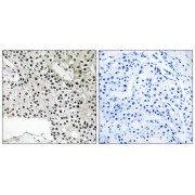 Immunohistochemistry analysis of paraffin-embedded human breast carcinoma tissue using TCEAL4 antibody.