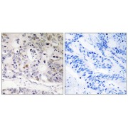 Immunohistochemistry analysis of paraffin-embedded human colon carcinoma tissue using UBTD1 antibody.