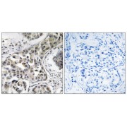 Immunohistochemistry analysis of paraffin-embedded human breast carcinoma tissue using USP6NL antibody.