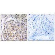 Immunohistochemistry analysis of paraffin-embedded human breast carcinoma tissue using GPR116 antibody.