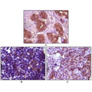 Immunohistochemical analysis of paraffin-embedded human breast tissue (A), lymph tissue (B) and skin carcinoma (C), showing membrane localization using BLK antibody with DAB staining.