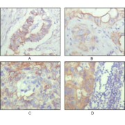 Immunohistochemical analysis of paraffin-embedded human ovary carcinoma (A), kidney carcinoma (B), lung carcinoma (C) and breast carcinoma (D), showing cytoplasmic and membrane localization with DAB staining using ALCAM antibody.