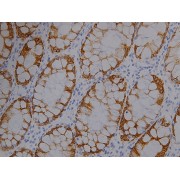 IHC analysis (400X) of CK19 expression in colon cancer, using CK19 antibody (1:1000 dilution).