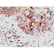 abx431233 (5 µg/ml staining of paraffin embedded Human Breast Carcinoma. Steamed antigen retrieval with citrate buffer pH 6, AP-staining.