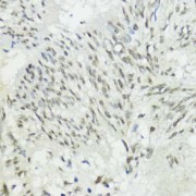 Immunohistochemistry of paraffin-embedded Human gastric cancer using ZEB1 Antibody (1/200 dilution, 40x lens).