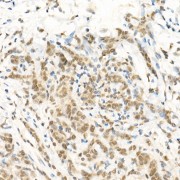 Immunohistochemistry of paraffin-embedded human breast cancer using RGS2 Antibody (1/100 dilution, 40x lens). High pressure antigen retrieval was performed in 10 mM citrate buffer pH 6.0 before commencing with IHC staining protocol.