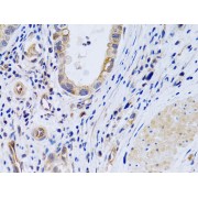 Immunohistochemistry of paraffin-embedded Human gastric cancer using PTGIR Antibody (1/200 dilution, 40x lens).