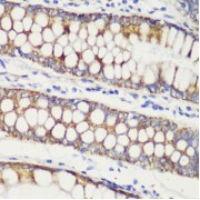 Immunohistochemistry of paraffin-embedded Human colon carcinoma using TOM20 Antibody (1/100 dilution, 40x lens).