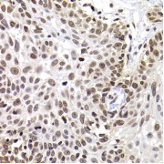 Immunohistochemistry of paraffin-embedded Human well-differentiated squamous skin carcinoma using PHIP Antibody (1/100 dilution, 40x lens).