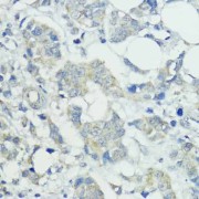 Immunohistochemistry of paraffin-embedded Human mammary cancer using SOCS5 Antibody (1/100 dilution, 40x lens).