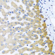 Immunohistochemistry of paraffin-embedded Human liver damage using M6PR Antibody (1/100 dilution, 40x lens).