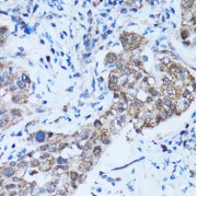 Immunohistochemistry of paraffin-embedded Human lung cancer using Caspase-3 Antibody (1/100 dilution, 40x lens).