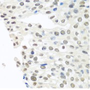 Immunohistochemistry of paraffin-embedded Human prostate cancer using TARDBP Antibody (1/100 dilution, 40x lens).